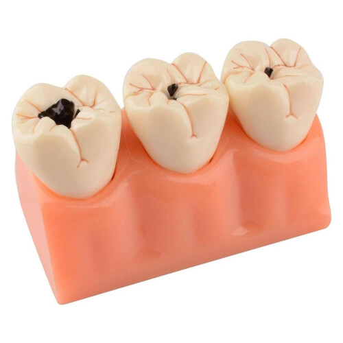 Dental Caries Teeth Model for Education, Realistic Removable Resin Teeth with Cavity Visualization 1