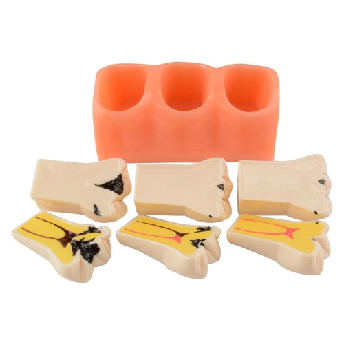 Dental Caries Teeth Model for Education, Realistic Removable Resin Teeth with Cavity Visualization 2