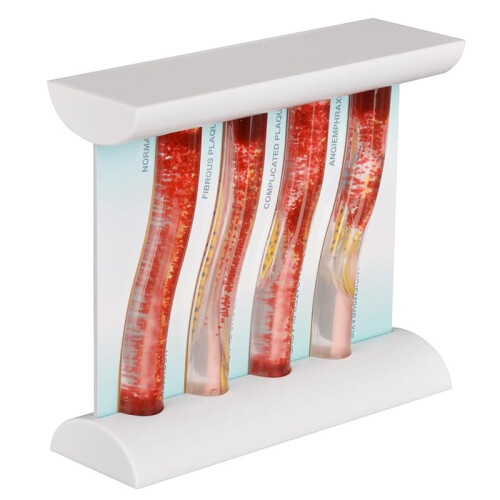 LDL Cholesterol Blood Vessel Model, 4-Stage Vascular Disease Teaching and Training Tool