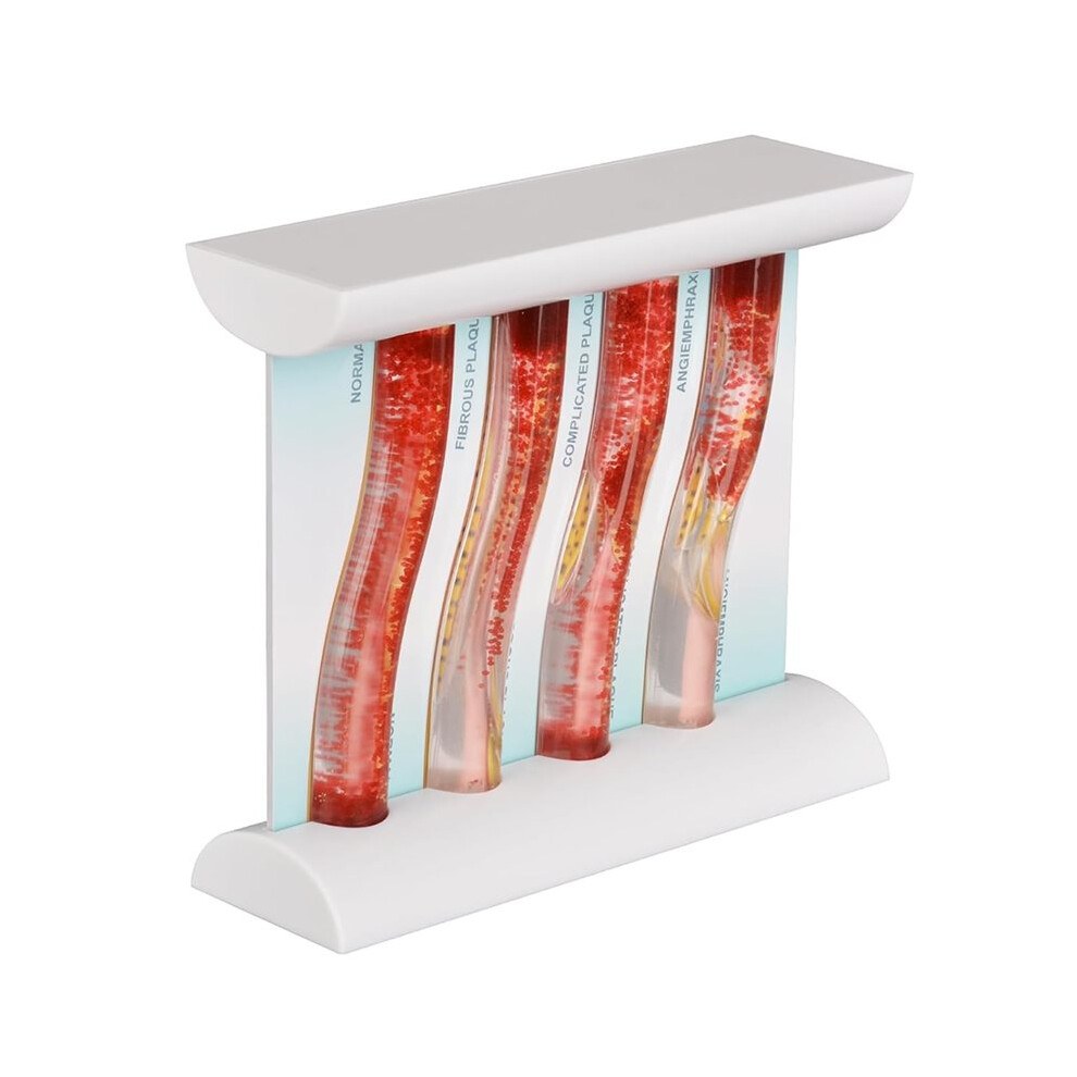 LDL Cholesterol Blood Vessel Model, 4-Stage Vascular Disease Teaching and Training Tool