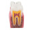 Dental Caries Model Tooth 6X Decay Demonstration for Teaching Labs 12