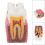 Dental Caries Model Tooth 6X Decay Demonstration for Teaching Labs 15