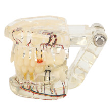 Transparent Dental Implant Pathology Model for Teaching & Restoration