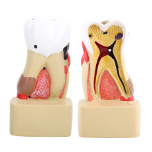 Dental Disease Tooth Model for Education, 10x5x3cm, Durable Resin