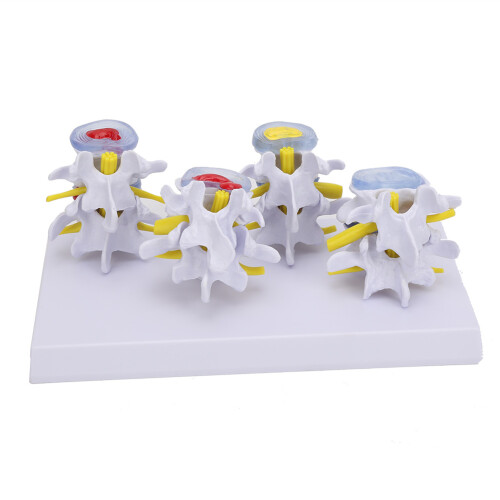 4-Stage Human Lumbar Vertebrae Model Set – Normal & Pathological PVC 1