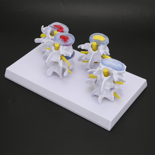 4-stage Lumbar Vertebrae Models, 1 set, PVC, color 2