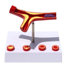 Artery Disease Model with 10x Enlarged Detail, Four Stages, PVC Medical Anatomy for Teaching