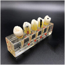 Dental Endodontic Treatment Model with Detachable Crown, Premolar Caries Teaching and Anatomy