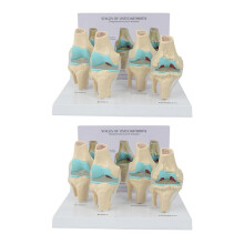 2X Knee Kit Osteoarthritis Anatomy Model with Educational Key Card 4 Stage Knee Model Orthopedic Teaching Aids