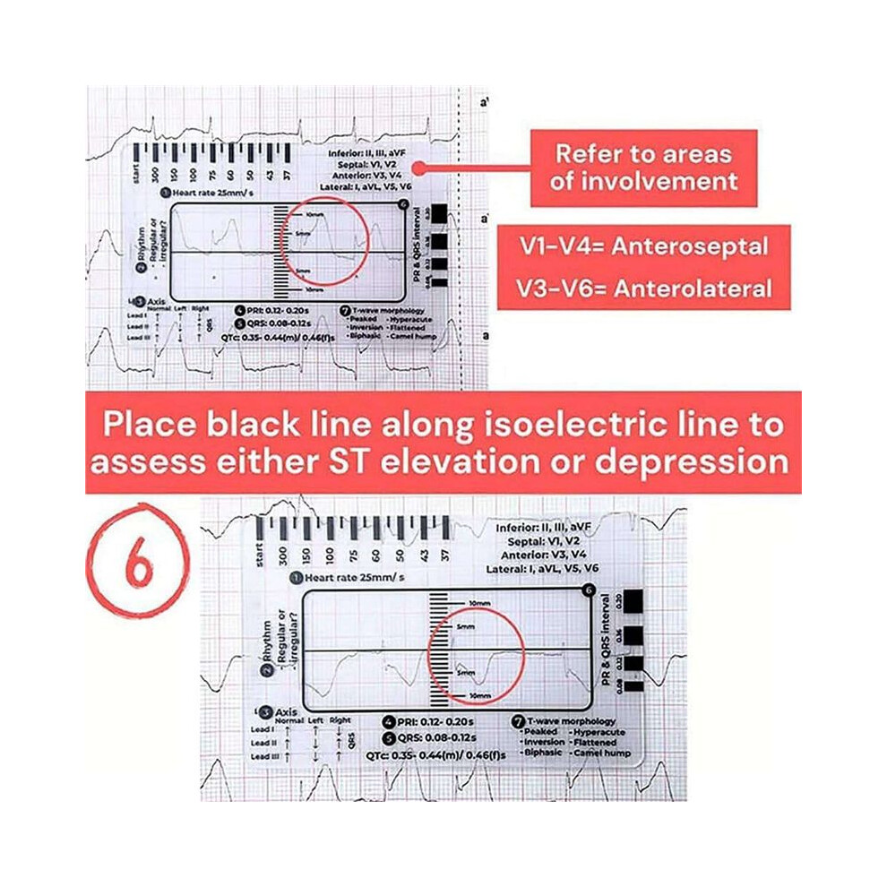 6pcs ECG 7 Step Ruler,ECG 7 Step Ruler for ECG/EKG Interpretation,ECG Reference Guide Ruler,EKG Calipers Measuring Tool
