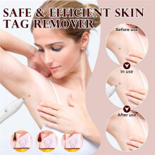 SkinTag Remover Pen Kit, Targets Common Skin Tags & Wart-Like Blemishes Friendly Home Use