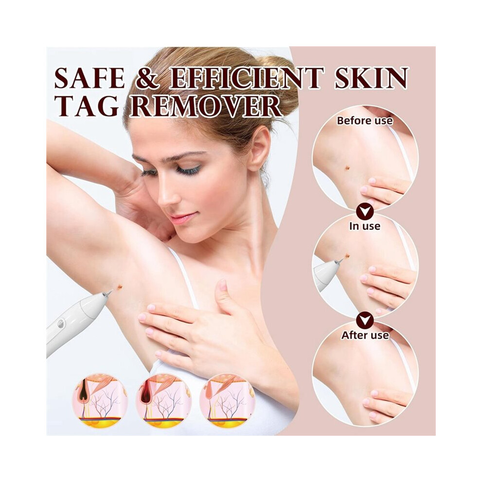 SkinTag Remover Pen Kit, Targets Common Skin Tags & Wart-Like Blemishes Friendly Home Use