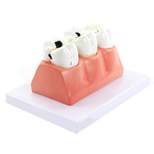 Dental Caries Model with ThreeStage Removable Teeth and Realistic CrossSection for Oral Education