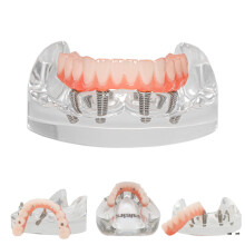 Dental Implant Model with Removable Overdenture and 4 Implants for Lower Jaw Training