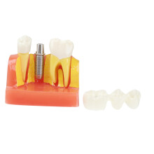 Dental Teaching Model 4X Enlarged Detail with Removable Teeth for Dental Anatomy Education