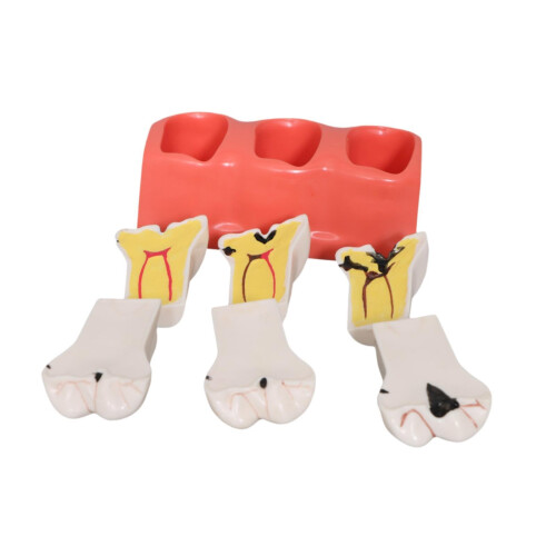 Dental Teaching Model with Realistic Decay Simulation, Removable Resin Tooth for Classroom