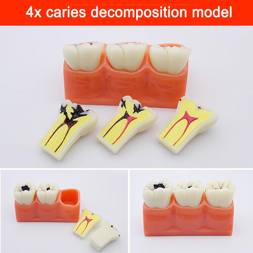 Dental Pathology Model with Removable Teeth and Deep Decay Visualization for Teaching and Demonstration 1