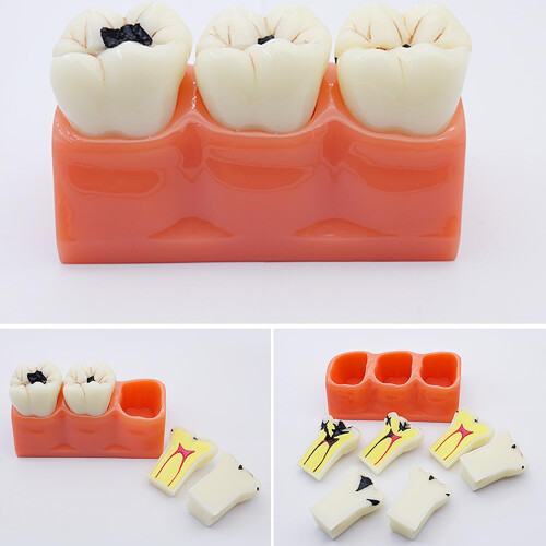 Dental Pathology Model with Removable Teeth and Deep Decay Visualization for Teaching and Demonstration 2