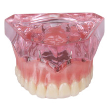Dental Implant Model for Overdenture Training with Clear Visual Demonstration and Patient Education Tool