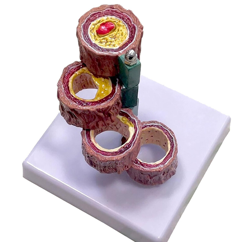 Anatomical Vascular Model with Clear Disease Progression, 4 Stage Atherosclerosis, 10x Life Size