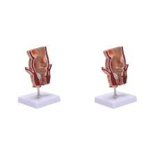 2X Anatomie Modell Menschliches Rektales Hämorrhoiden Läsion Modell Hämorrhoiden Fistel Fistel Fissur Pathologie Lehren Modell