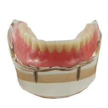 Dental Implant Model with Clear Visualization and Realistic Tooth Anatomy for Teaching and Study