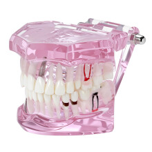 Dental Implant Training Model Typodont with Lifelike Tooth Anatomy for Implant Placement Practice