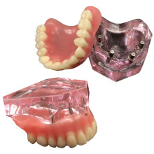 Dental Implant Model with Removable Overdenture, Transparent Upper Jaw 4 Implant Teaching Tool