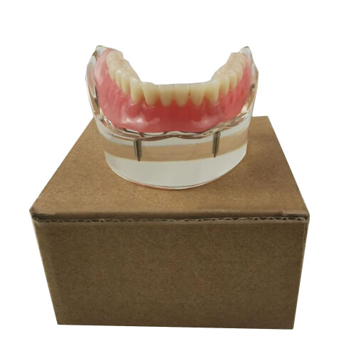 Dental Implant Model with Clear Visualization and Realistic Tooth Anatomy for Teaching and Study 1