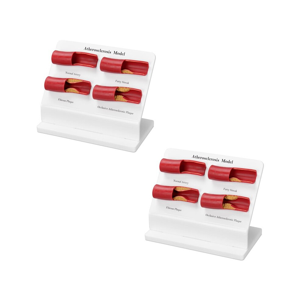 Human Atherosclerosis Model, Four-Stage Vascular Disease Artery with Plaque for Anatomy Education 2pcs