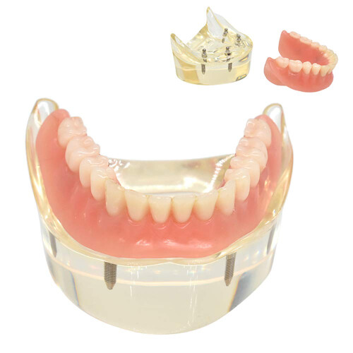 Dental Teaching Model Lower Jaw Overdenture with 4 Implants for Hygiene Training and Demonstration