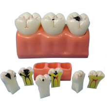Dental Caries Model with Clear Caries Progression View for Patient Education and Classroom Training