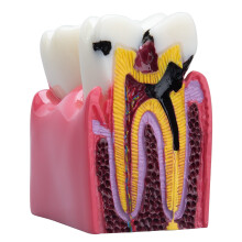 Dental Caries Model with Enlarged CrossSection View, Bilateral Anatomy Comparison Tooth Decay Teaching