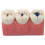 Dental Caries Model with Clear Caries Progression View for Patient Education and Classroom Training 3