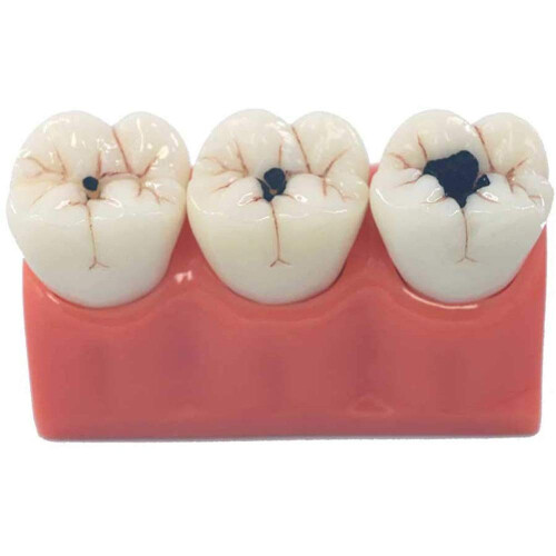Dental Caries Model with Clear Caries Progression View for Patient Education and Classroom Training 2