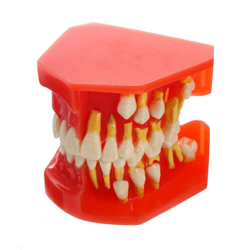 Dental Implant Model with Removable Teeth and Visible Interface for Kids and Adults Study Training 1