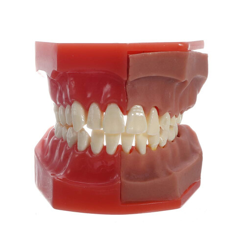Dental Implant Model with Removable Teeth and Visible Interface for Kids and Adults Study Training 2