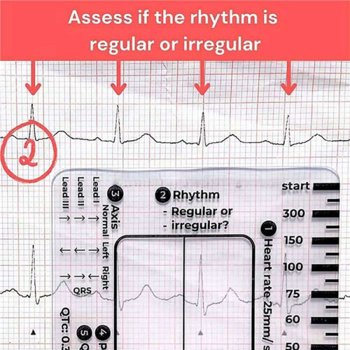 8 Pezzi ECG 7 Step Ruler, ECG 7 Step Ruler per Interpretazione ECG/EKG, ECG Reference Guide Ruler, EKG Calipers Measuring Tool 2