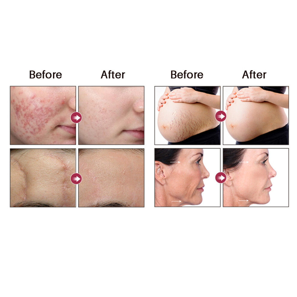10ml Rosehip Seed Oil Cold Pressed Moisturizer for Face, Fine Lines & Scars