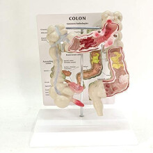 Colon Anatomy Model with Lesions and Appendix, Half Life Size Educational Display for Medical Training