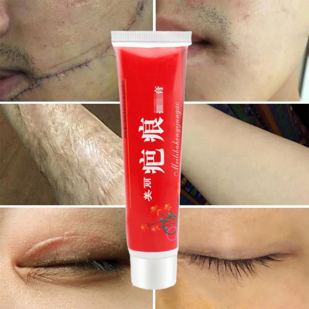 Cream 60G Acne Scar Removal Fade Scars & Itch Relief Peeling