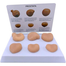 Prostate Anatomy Model Set with Six Variations, Realistic Lesion Display, Stand and Instructional Card