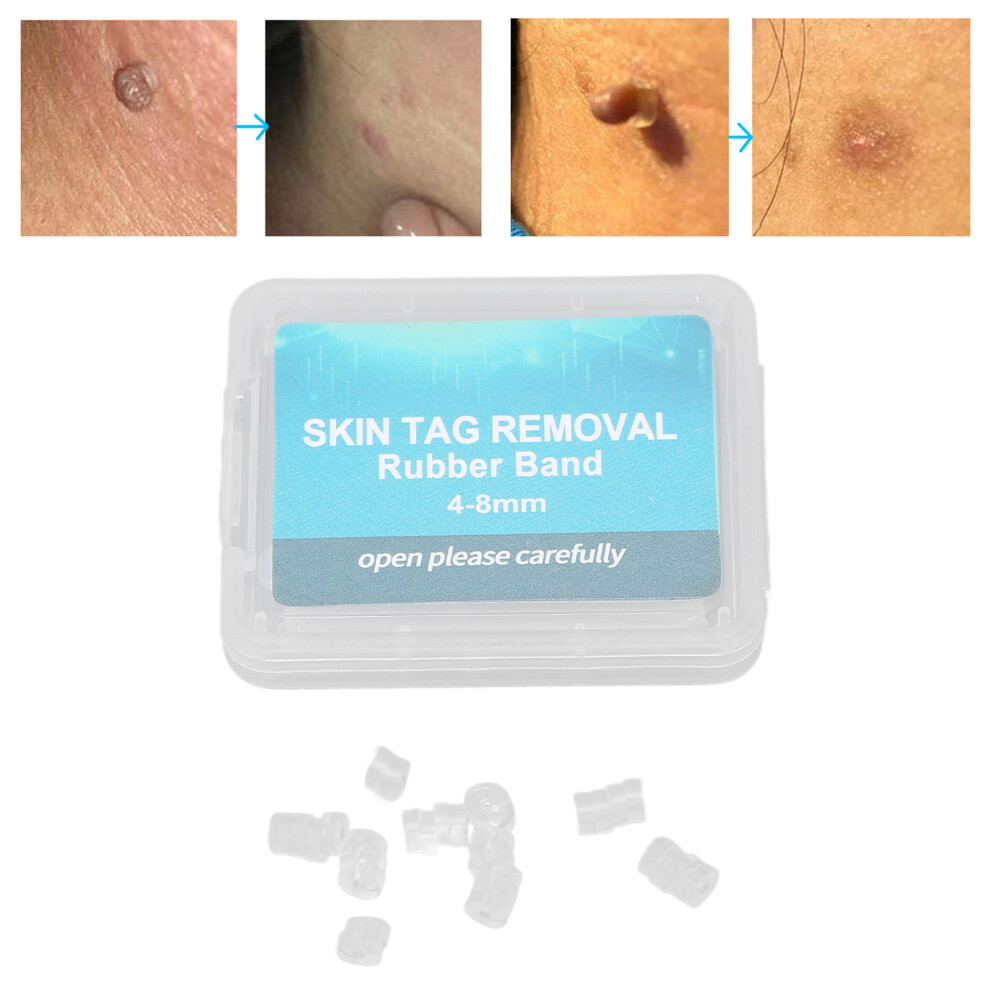 30pcs Skin Tag Remover Rubber Rings Kit for Face, Neck, Body