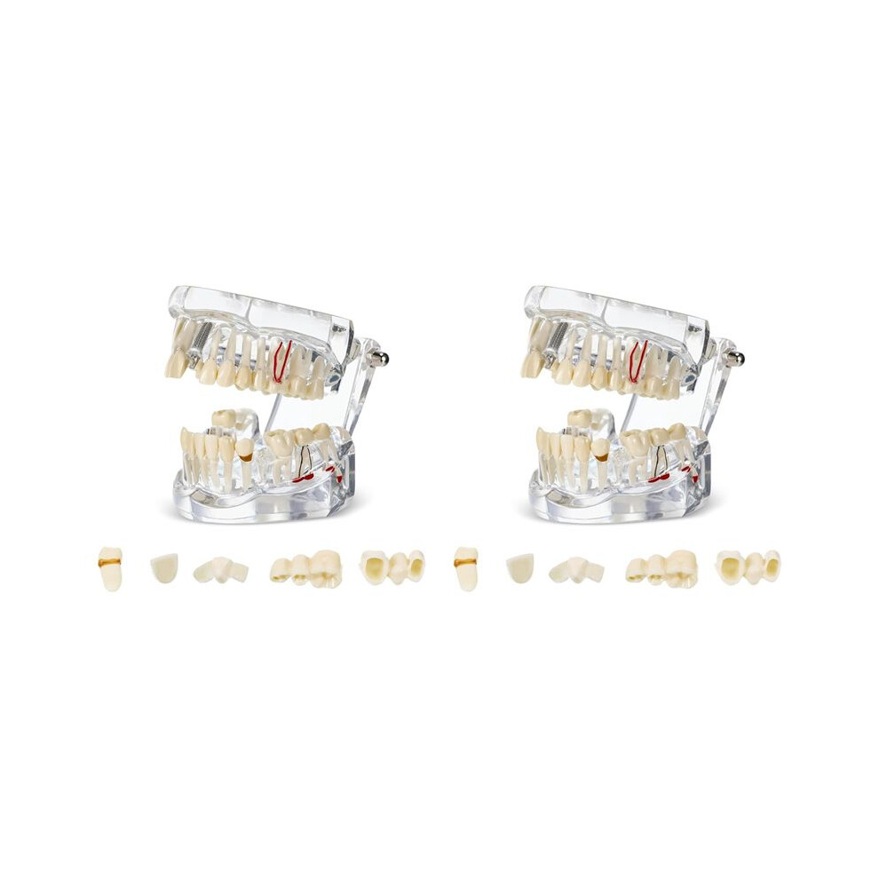 2X Disease Teeth Model Dental Typodonts Implant Teeth Model With Removable Teeth Dentist Standard Tooth Demonstration 6031541325295