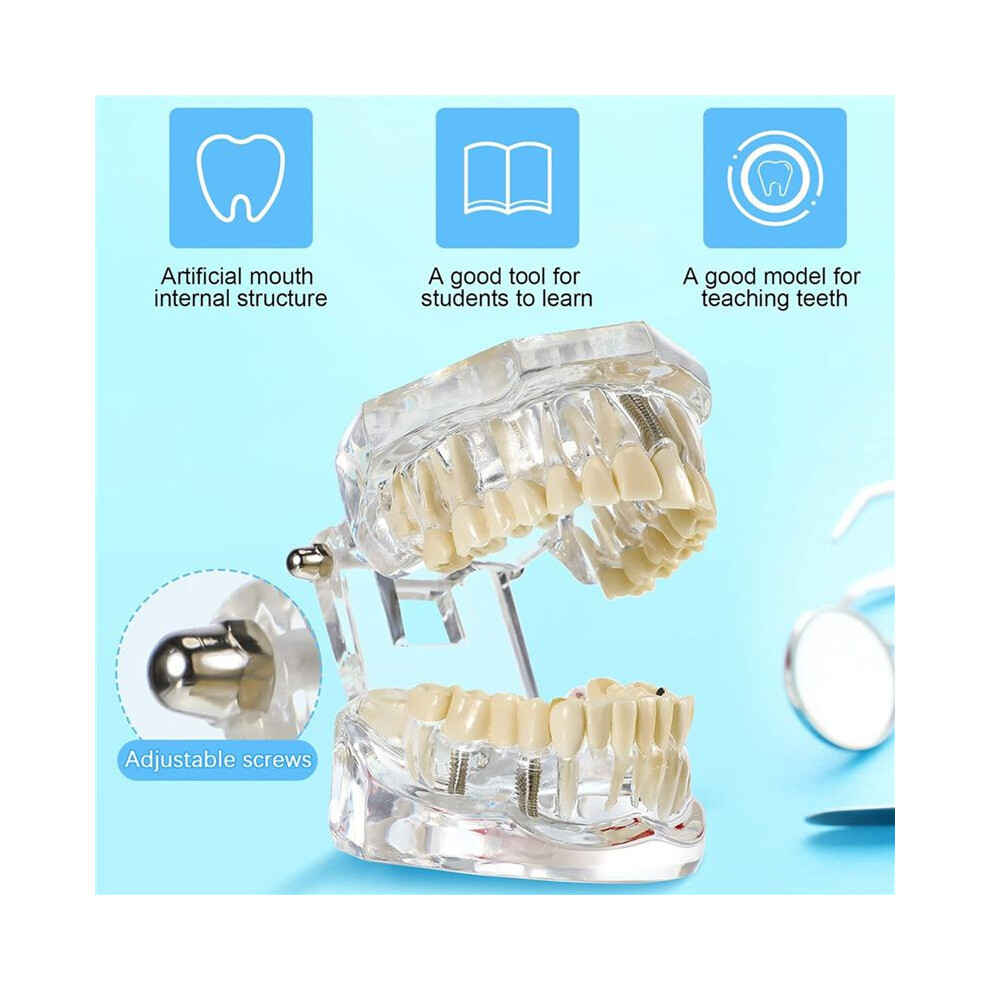 2X Disease Teeth Model Dental Typodonts Implant Teeth Model with Removable Teeth Dentist Standard Tooth Demonstration