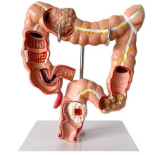 Large Intestine Anatomy Model with Pathology Display for Medical Teaching and Research