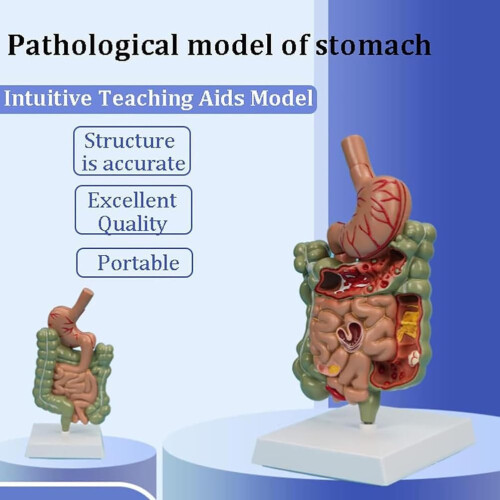 Human Colon Anatomy Model with Clear Lesion Visualization, Removable Digestive System Pathology Model 1
