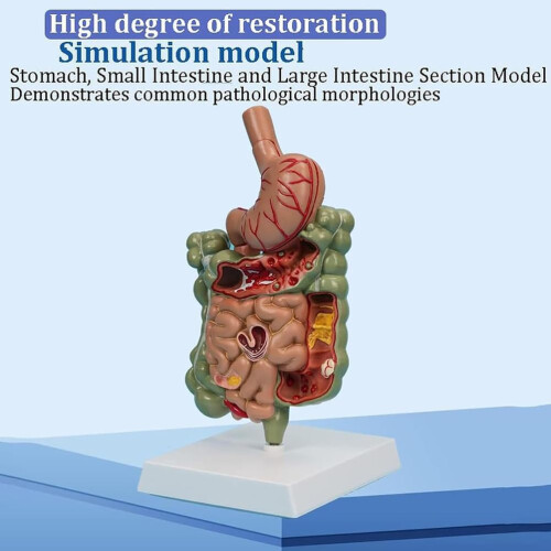 Human Colon Anatomy Model with Clear Lesion Visualization, Removable Digestive System Pathology Model 2