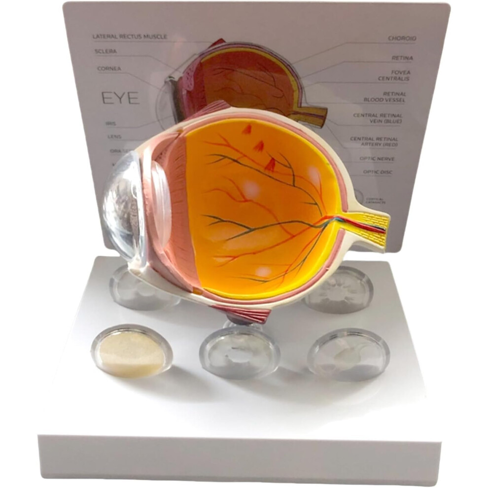 Anatomical Eye Model with Glaucoma Pathology, Magnified Detachable Parts for Teaching and Clinic