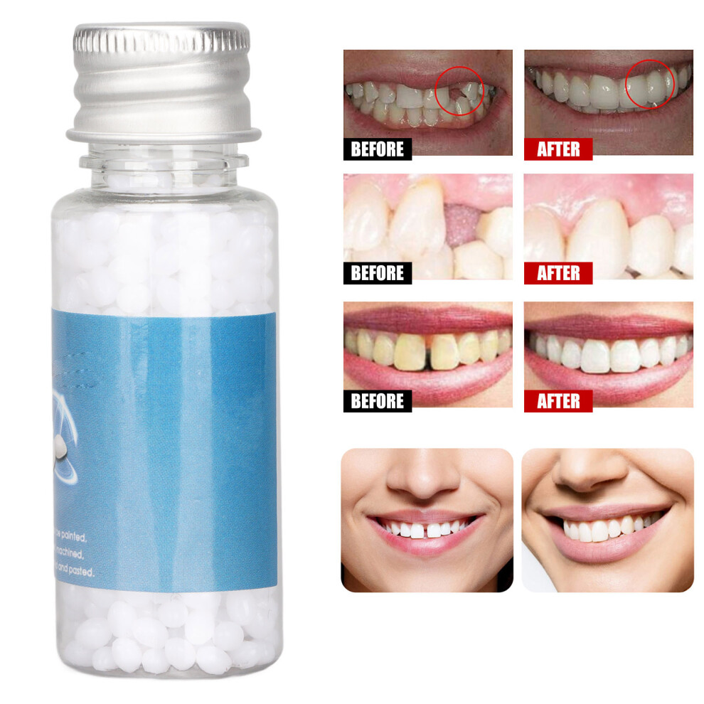 White Tooth Repair Beads Fix Kit - Resin, Medium Bottle, Temporary Dental Repair